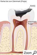 Zahn mit Karies